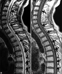 A comorbid patient with chronic pain syndrome. Chronic Lymphocytic Inflammation With Pontine Perivascular Enhancement Responsive To Steroids And Human Leukocyte Antigen Tohge R Nagao M Neurol India