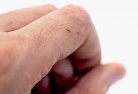 However, you might also use tape, glue, a needle or pliers. How To Remove A Splinter Methods And Tips
