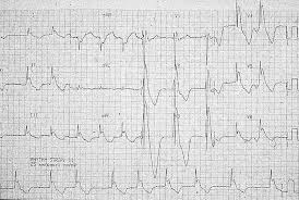 Just below the answer, you will be guided to the complete puzzle. Osborn Wave J Wave Litfl Ecg Library Basics
