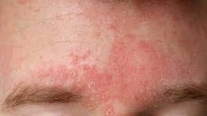 Image result for Beard Dermatitis