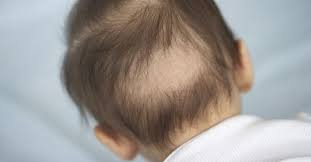 Hair Loss In Babies Babycenter Baby Hair Loss Baby Losing Hair Baby Hairstyles