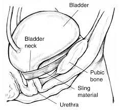 Sling Operation For Stress Incontinence Google Search Stress Incontinence Bladder Incontinence