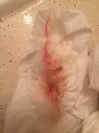 Tmi Bloody Show Mucus Plug Pics Is This From Cervical Exam Babycenter
