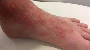 Image result for Trombicula autumnalis bites