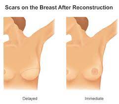 How much does breast reconstruction cost after mastectomy. Immediate Breast Reconstruction Manhattan Ny Dr Oren Lerman