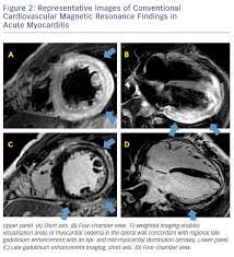 Ein in der mrt nachweisbares lge ist dabei nachweislich mit einer ungünstigeren prognose und einer erhöhten rate kardialer ereignisse assoziiert. Advances In Cardiovascular Mri Using Quantitative Tissue Characterisation Techniques Focus On Myocarditis Ecr Journal