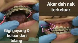 Penggunaan pendakap gigi yang palsu atau pemasangan pendakap gigi oleh individu yang tidak bertauliah boleh mengundang pelbagai jenis risiko dan penyakit berbahaya seperti tibi. Pendakap Gigi