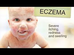 Eczema is an allergic skin condition that's also called atopic dermatitis. Eczema In Babies Effective Treatment Of Dry Skin Conditions