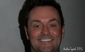 Replacement of Old Veneers