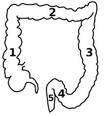 Two distinct animal models for polymicrobial sepsis. Kolorektales Karzinom Wikipedia