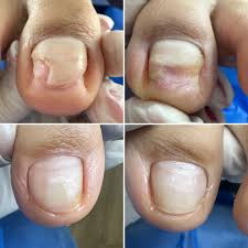 Image result for Onycholysis feet