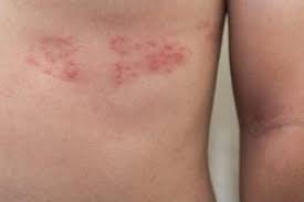 Image result for herpes zoster