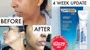 What to expect from diferin gel Differin Gel Retinoid Made My Skin Worse 4 Week Update Review Adapalene Gel 0 1 Youtube