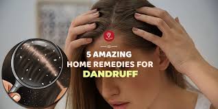 Treating your hair with coconut oil is another viable home solution for dandruff and furthermore functions admirably on however, people can also help eliminate dandruff at home using the natural remedies below. 5 Amazing Home Remedies For Dandruff 7pranayama Com