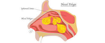 Search for nasal polyps on topwebanswers.com! London Ent Associates Nasal Polyps