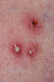Image result for Fire Ant Sting