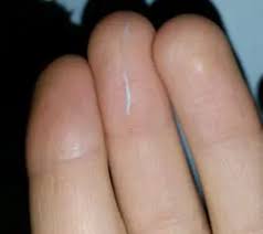 Wurmer Im Stuhl Naturliche Behandlung Online Wurm Test