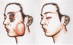 schematic drawing of the surgical methods for the divided nevus of the...