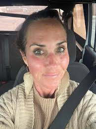 I have not been good about taking care of my skin. Grateful for this  ￼Liquid gold! Stem cell, PRP facial! First picture is right after I had it  done, the other photo