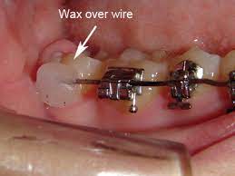Meade explains what to do when you get a broken wire at home before you are able to come in and see us to get it fixed! Emergency Care Goldreich Orthodontics Plano Tx