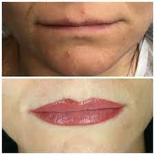 Lips Reconstruction After A Childhood Burn On The Upper Lip Permanent Makeup Lips Befor Permanent Makeup Lips Before After Lip Cosmetics Permanent Makeup Lips