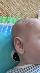 Image result for Cradle Cap