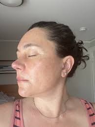 Neogen Plasma Healing Process Pics