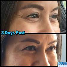 There are several factors that come into play, like why you're taking the probiotic, the state of your health, and the strains you're taking, to name a few. A Happy Client Just Sent Us Her Photos 3 Days After Dysport Injections For Her Crow S Feet Have An Event Dysport Can Start W Dysport Botox Plastic Surgery