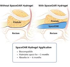 The american cancer society provides detailed information on prostate cancer and its treatment. First Proton Therapy Center Using New Product To Benefit Prostate Cancer Patients Imaging Technology News
