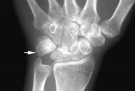 Image result for Pisiform Bone