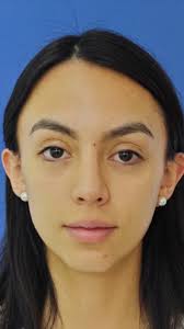 Rinoplastia en Ciudad Satélite