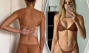 Natalie Roser joins the straight spine club after years of battling  scoliosis | Daily Mail Online
