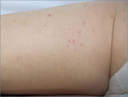 Affordable laser hair removal 31 southwick st london w2 1jq. Aesthetics Eufoton