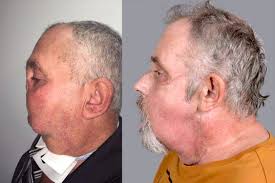 After the transplant, when underwood's face had healed and the inflammation had subsided, dr. First Canadian Face Transplant Performed In Montreal Udemnouvelles