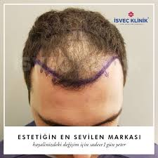 Hairtransplant Hairtransplant Hair Transplantation راعة الشعر Sac Ekimi Ekimi Hair Hairtransplant S Haartransplantation Beckham Frisur Haare