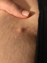 Boils On Buttocks Crack