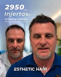 Turkish Hair Transplant in Cancun/Mexico