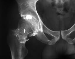 A gunshot wound (gsw) is physical trauma caused by a projectile from a firearm. Gun Shot Wounds Trauma Orthobullets