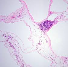 Picture in pathology multilocular peritonial inclus. Pathology Outlines Multicystic Mesothelioma