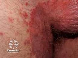 Image result for sore skin in the groin area