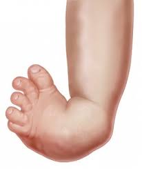 The top of the foot is usually. Clubfoot Symptoms Causes And Treatment Options