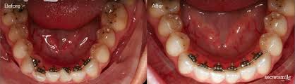 Search for how long do you have braces. What Are Lingual Braces Birchgrove Dental
