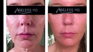 See more ideas about thread lift face, plastic surgery, face lift surgery. Mint Thread Lift Using Pdo Threads Say Adios To Sagging Jaw Line Sagging Cheek Youtube