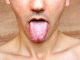 Get more insights on how to clean your tongue naturally using different method and reagent like baking soda. How To Clean Tongue Naturally à¤œ à¤­ à¤µà¤° à¤¸ à¤šà¤² à¤² à¤¸à¤« à¤¦ à¤˜ à¤£ à¤¥à¤° à¤…à¤¸à¤¤ à¤†à¤œ à¤° à¤š à¤²à¤• à¤·à¤£ à¤¯ à¤¨ à¤¸à¤° à¤— à¤• à¤ªà¤¦ à¤§à¤¤ à¤¨ à¤•à¤° à¥¨ à¤® à¤¨ à¤Ÿ à¤¤ à¤œ à¤­ à¤¸ à¤« Causes Of White Tongue And Natural Home Remedies For It