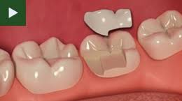 Inlays & Onlays Glasgow