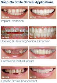 What smile problems does it address? Snap On Smile Mabel Dental Lab