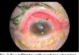 Image result for Gonococcal Conjunctivitis
