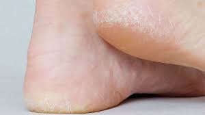 What causes dead skin buildup on feet? Take Steps At Home To Manage Dry Cracked Heels South Florida Sun Sentinel South Florida Sun Sentinel