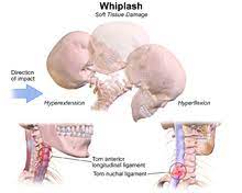 Whenever the neck is thrown out of. Whiplash Medicine Wikipedia