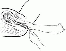 This film explains what a retained placenta is, why it is important to be removed and the essential steps that need to be taken. Mcpc Manual Removal Of Placenta Health Education To Villages